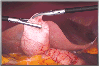 최첨단 3D 복강경 담낭절체술